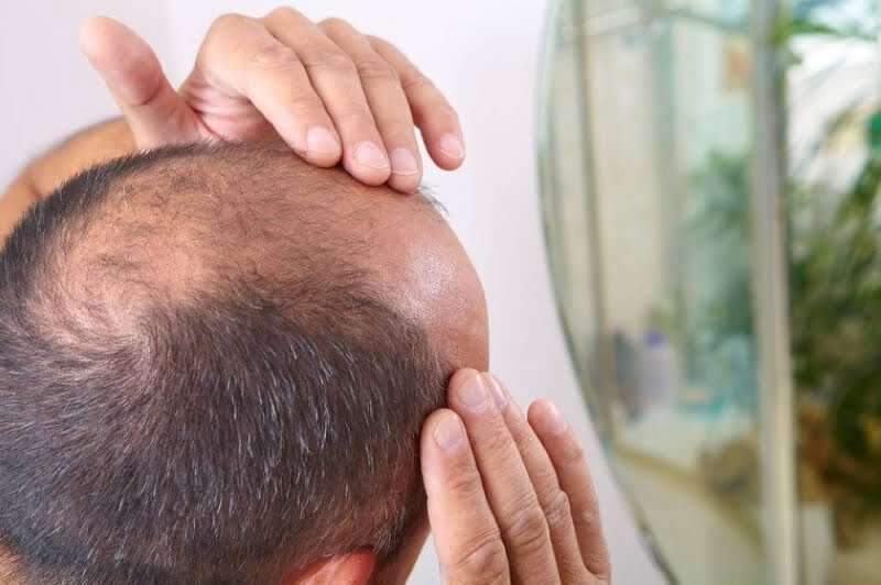 احذر.. مشروبات شائعة تسبب الصلع السريع وتساقط الشعر لدى... مساحة نت | احذر.. مشروبات شائعة تسبب الصلع السريع وتساقط الشعر لدى الرجال