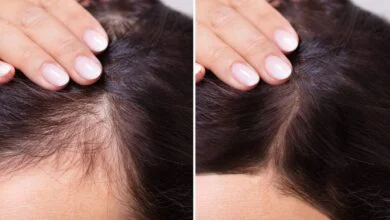 أفضل من مراكز زراعة الشعر.. علاج منزلي طبيعي للصلع والصلع...