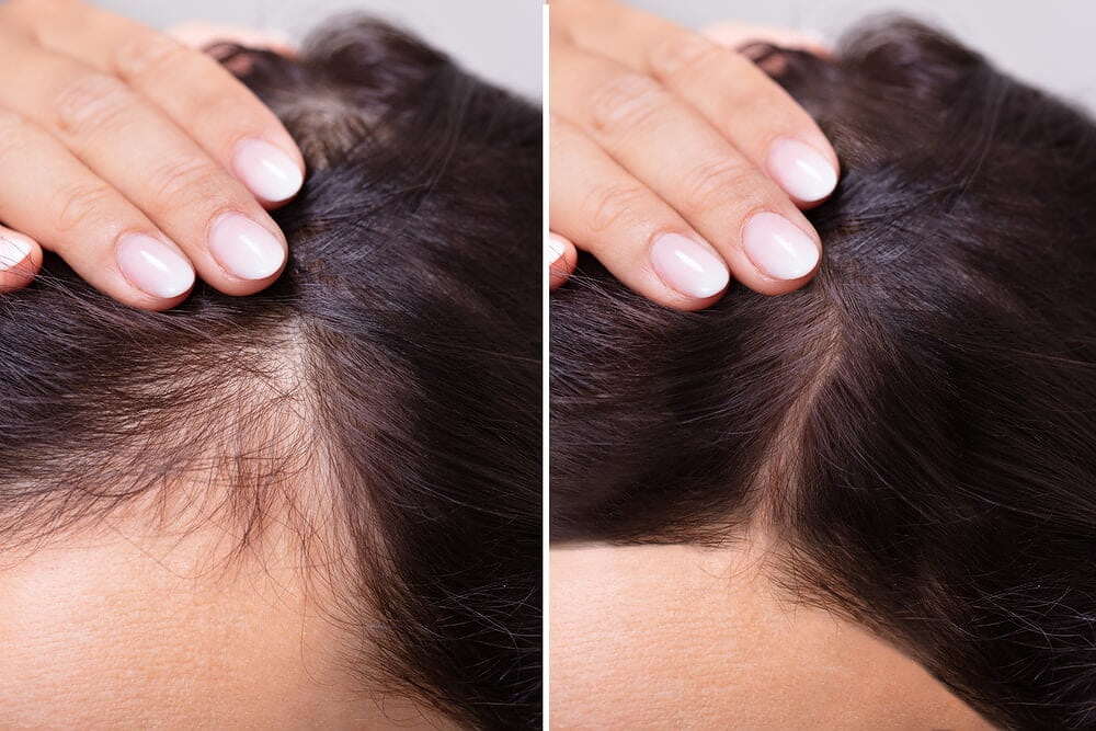 أفضل من مراكز زراعة الشعر.. علاج منزلي طبيعي للصلع والصلع... أفضل من مراكز زراعة الشعر.. علاج منزلي طبيعي للصلع والصلع...