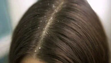 طرق طبيعية مدهشة للتخلص من قشرة الرأس بسرعة البرق.. جربيها...