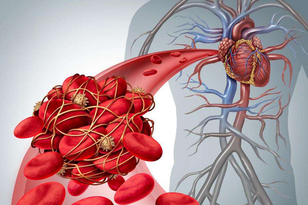احذر.. هذه الأطعمة 'تمنع الدم من الحركة' وتسبب جلطات دموية... احذر.. هذه الأطعمة 'تمنع الدم من الحركة' وتسبب جلطات دموية...
