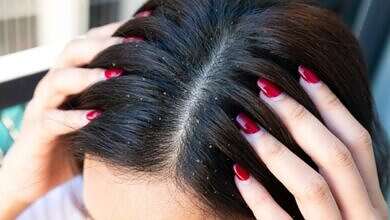 قشرة الشعر (مواقع)