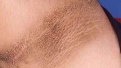 إزالة سواد الرقبة (مواقع)