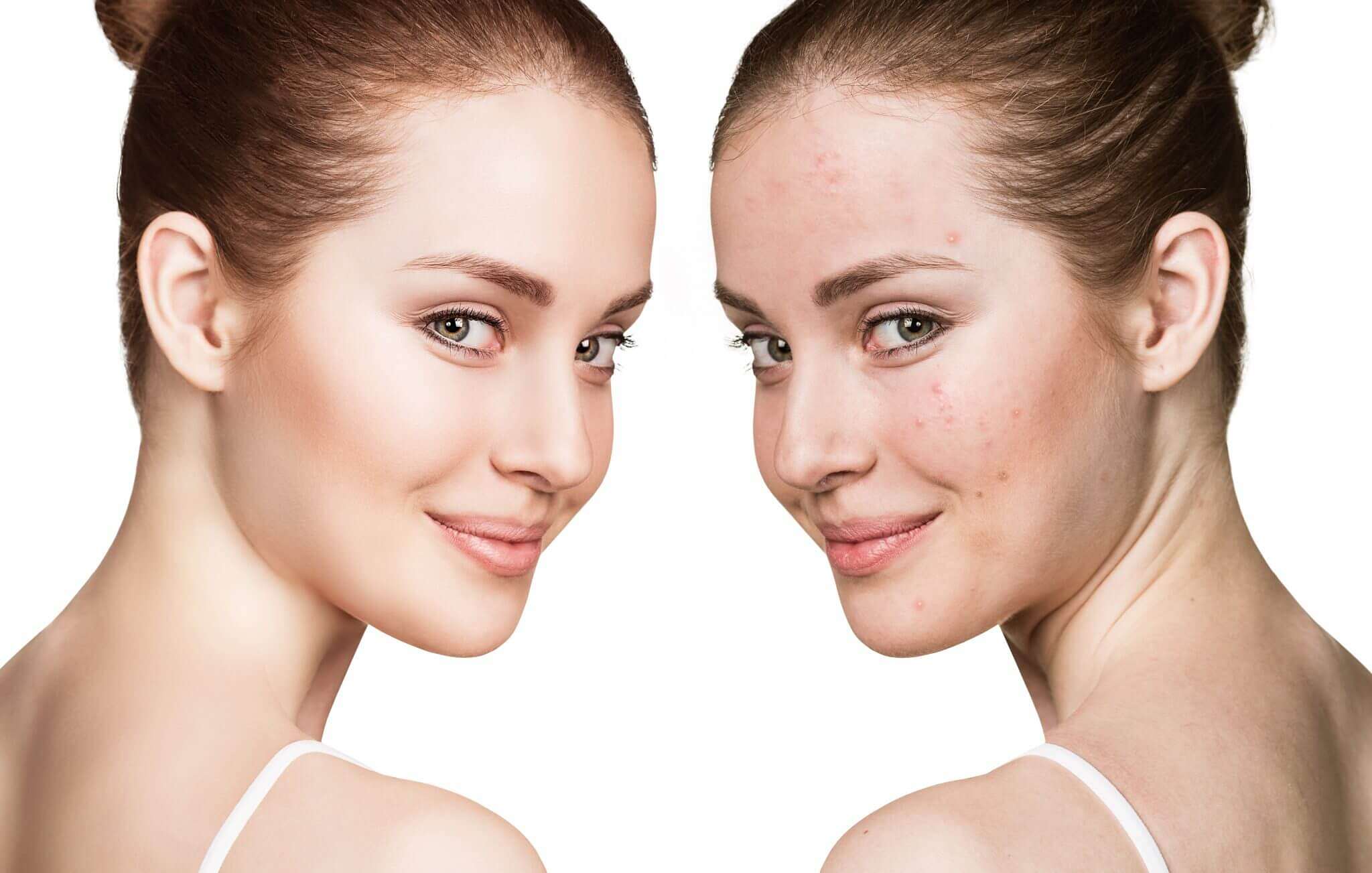 حب الشباب حب الشباب على الوجه (facesspa)