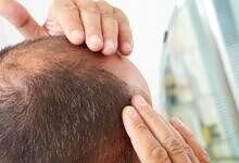 علاج تساقط الشعر (مواقع)