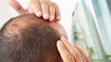 علاج تساقط الشعر (مواقع)
