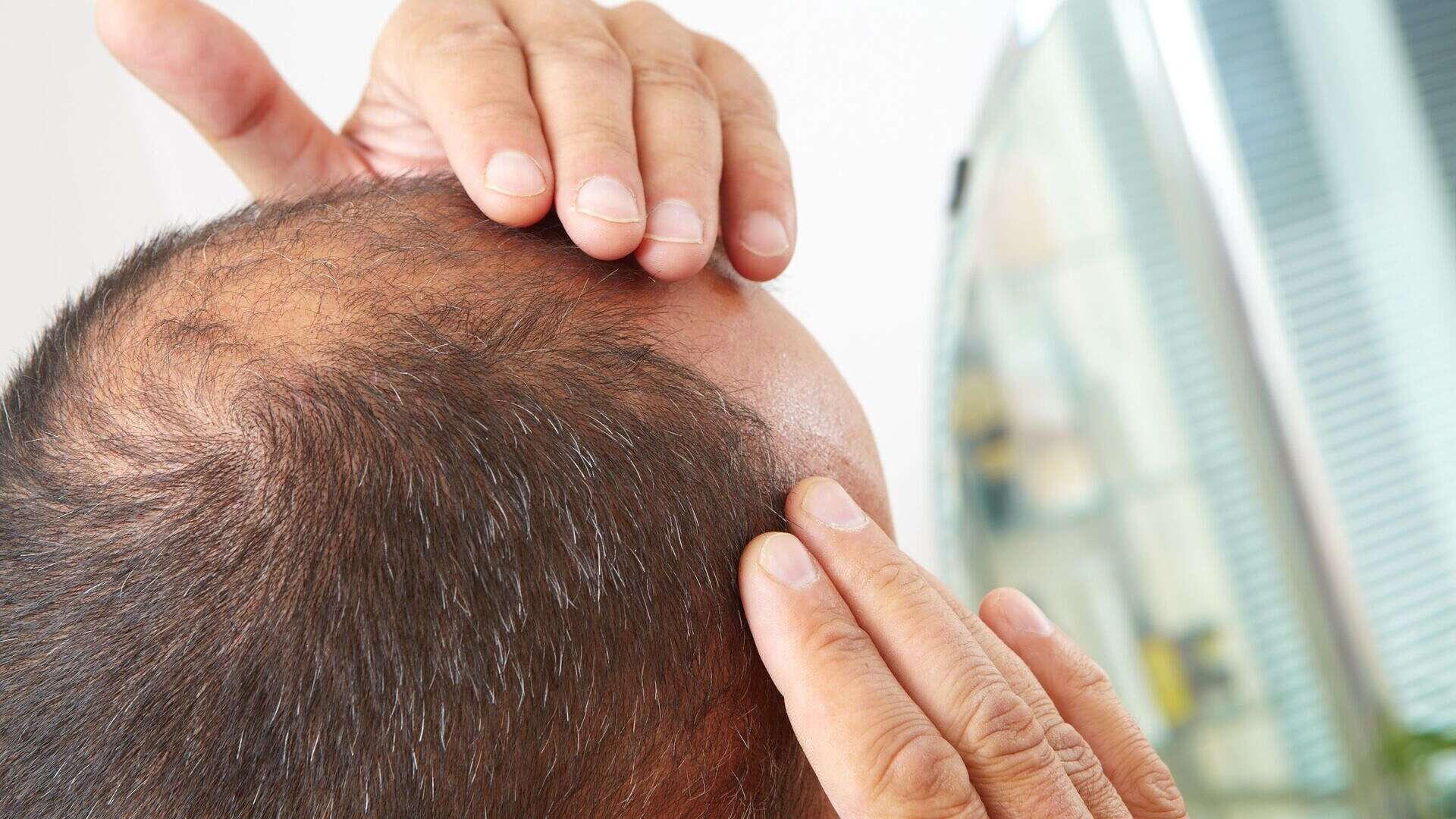 صلع علاج تساقط الشعر (مواقع)