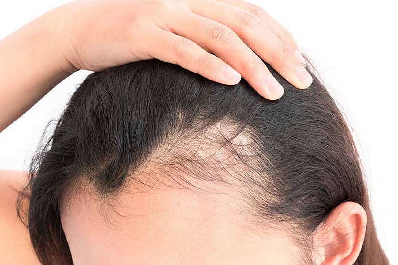 وداعاً للثعلبة نهائياً: أسرار مذهلة لاستعادة شعرك بكثافة