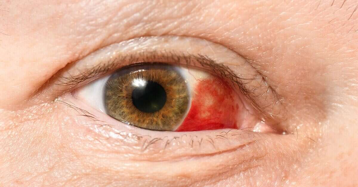 احمرار العين قد يكشف عن 5 أمراض خطيرة.. لا تتجاهل هذا العرض